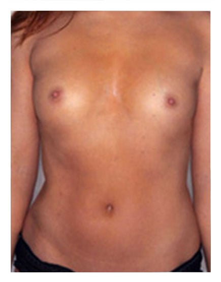 Fat Transfer to Breasts Before