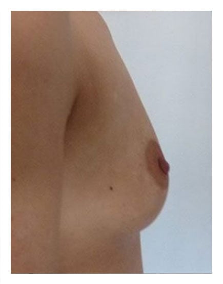 Fat Transfer to Breasts Before
