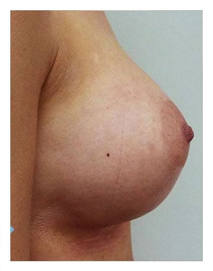 Fat Transfer to Breasts After