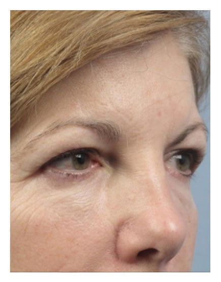 Surgical Brow Lift Before