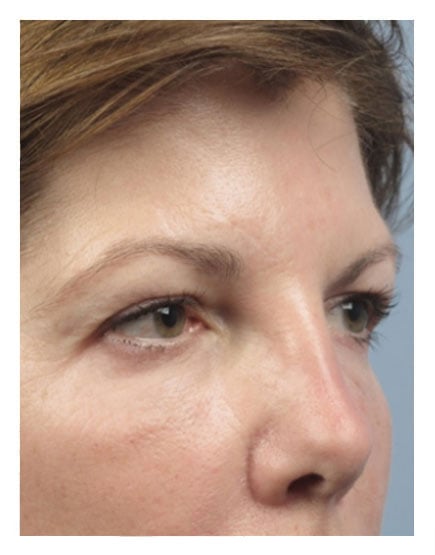 Surgical Brow Lift After
