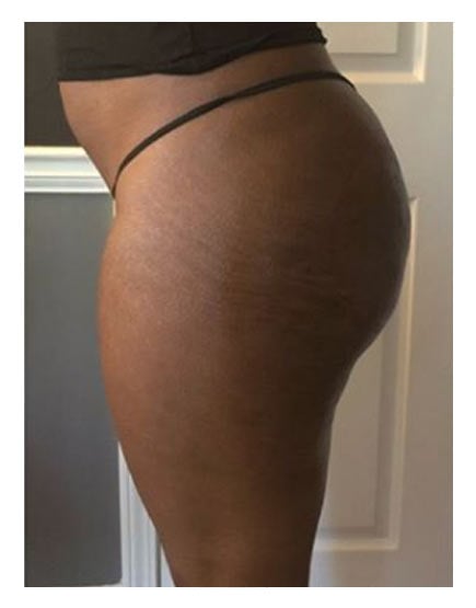 Cellulite After