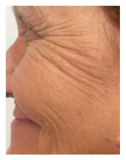 No Knife Facelift Before