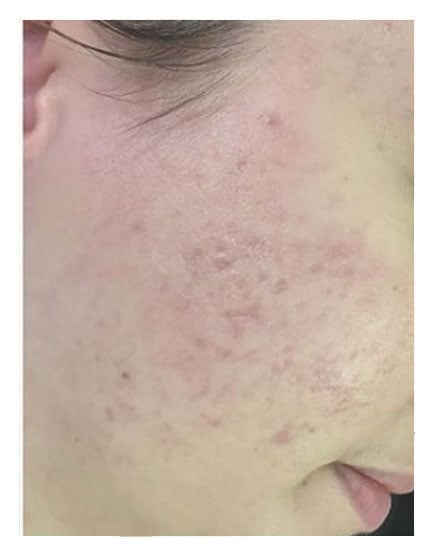 Microdermabrasion After