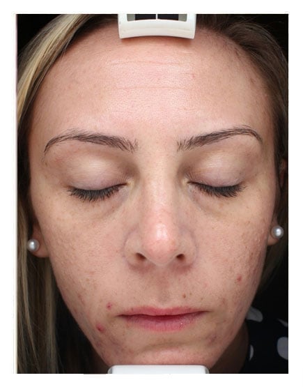 Photodynamic Therapy (PDT) Before