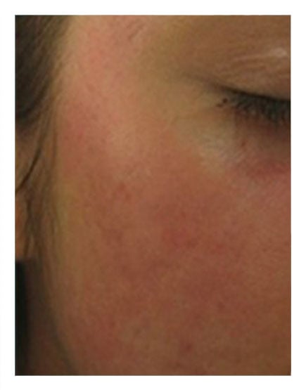 Chemical Peel After