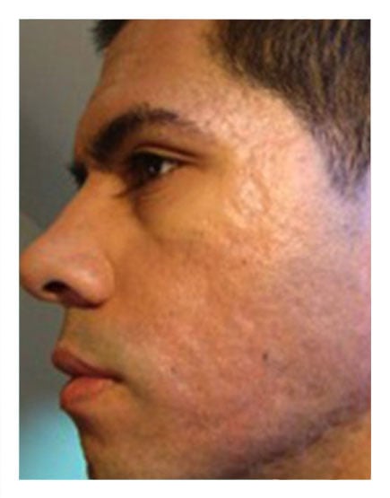 PRP Rejuvenation Facial After