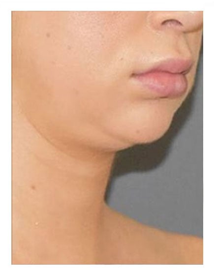 Vaser Lipsuction Before