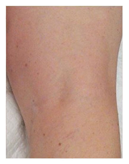 Sclerotherapy After