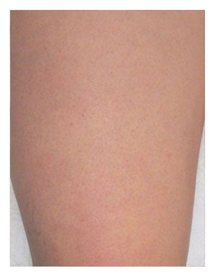 Sclerotherapy After