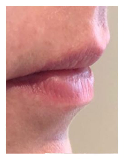 Lip Filler London Get Costs Before And Afters And Recovery Info 